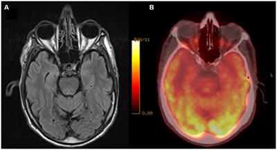 Lithium management of periodic mood fluctuations in behavioural frontotemporal dementia: a case report